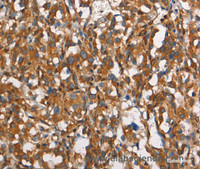 Immunohistochemistry of paraffin-embedded Human thyroid cancer tissue using CEACAM3 Polyclonal Antibody at dilution 1:30