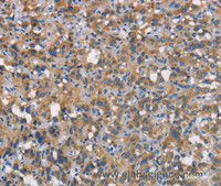 Immunohistochemistry of paraffin-embedded Human thyroid cancer tissue using CEACAM6 Polyclonal Antibody at dilution 1:70