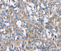 Immunohistochemistry of paraffin-embedded Human thyroid cancer using CDC25A Polyclonal Antibody at dilution of 1:50