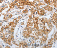 Immunohistochemistry of paraffin-embedded Human lung cancer using RTN4 Polyclonal Antibody at dilution of 1:40