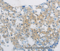 Immunohistochemistry of paraffin-embedded Human breast cancer tissue using CD303 Polyclonal Antibody at dilution of 1:70