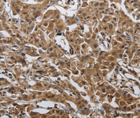 Immunohistochemistry of paraffin-embedded Human lung cancer tissue using PDCD7 Polyclonal Antibody at dilution 1:60