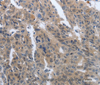 Immunohistochemistry of paraffin-embedded Human ovarian cancer tissue using PDGFB Polyclonal Antibody at dilution 1:40