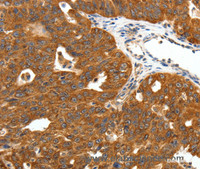 Immunohistochemistry of paraffin-embedded Human ovarian cancer tissue using SCN11A Polyclonal Antibody at dilution 1:50