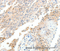 Immunohistochemistry of paraffin-embedded Human cervical cancer tissue using CXCL12 Polyclonal Antibody at dilution 1:40