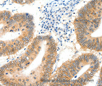 Immunohistochemistry of paraffin-embedded Human colon cancer tissue using SIPA1 Polyclonal Antibody at dilution 1:40