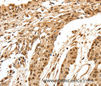 Immunohistochemistry of paraffin-embedded Human esophagus cancer using SPATA20 Polyclonal Antibody at dilution of 1:70