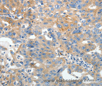 Immunohistochemistry of paraffin-embedded Human ovarian cancer using AKAP12 Polyclonal Antibody at dilution of 1:40