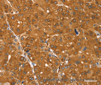 Immunohistochemistry of paraffin-embedded Human ovarian cancer tissue using SSTR3 Polyclonal Antibody at dilution 1:30