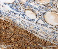 Immunohistochemistry of paraffin-embedded Human thyroid cancer tissue using TERT Polyclonal Antibody at dilution 1:50