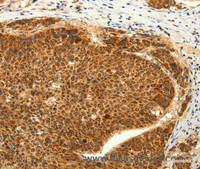 Immunohistochemistry of paraffin-embedded Human liver cancer tissue using TRPC6 Polyclonal Antibody at dilution 1:50