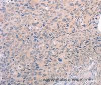 Immunohistochemistry of paraffin-embedded Human cervical cancer using EDG3 Polyclonal Antibody at dilution of 1:30