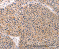 Immunohistochemistry of paraffin-embedded Human esophagus cancer tissue using ACIN1 Polyclonal Antibody at dilution 1:80