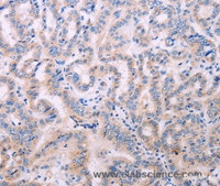 Immunohistochemistry of paraffin-embedded Human thyroid cancer tissue using ADCY5 Polyclonal Antibody at dilution 1:40
