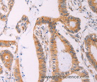 Immunohistochemistry of paraffin-embedded Human colon cancer tissue using ADCY1 Polyclonal Antibody at dilution 1:60