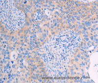 Immunohistochemistry of paraffin-embedded Human cervical cancer tissue using ADHFE1 Polyclonal Antibody at dilution 1:60