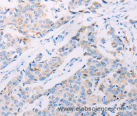 Immunohistochemistry of paraffin-embedded Human breast cancer tissue using AKT2 Polyclonal Antibody at dilution 1:70