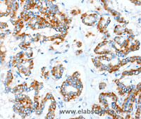 Immunohistochemistry of paraffin-embedded Human thyroid cancer tissue using ALDH5A1 Polyclonal Antibody at dilution 1:35