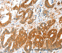 Immunohistochemistry of paraffin-embedded Human colon cancer tissue using ALDH5A1 Polyclonal Antibody at dilution 1:35