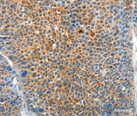 Immunohistochemistry of paraffin-embedded Human liver cancer tissue using SERPINF2 Polyclonal Antibody at dilution 1:50
