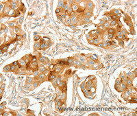 Immunohistochemistry of paraffin-embedded Human breast cancer using ACE1 Polyclonal Antibody at dilution of 1:70