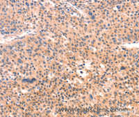 Immunohistochemistry of paraffin-embedded Human liver cancer tissue using APBA2 Polyclonal Antibody at dilution 1:80