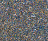 Immunohistochemistry of paraffin-embedded Human lymphoma tissue using PITX3 Polyclonal Antibody at dilution 1:40