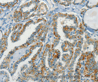Immunohistochemistry of paraffin-embedded Human thyroid cancer tissue using NPAP1 Polyclonal Antibody at dilution 1:70