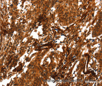 Immunohistochemistry of paraffin-embedded Human gastric cancer using ACTA2 Polyclonal Antibody at dilution of 1:40