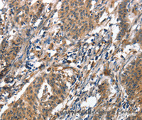 Immunohistochemistry of paraffin-embedded Human gasrtic cancer tissue using ALOX15 Polyclonal Antibody at dilution 1:50