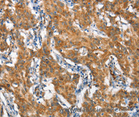 Immunohistochemistry of paraffin-embedded Human gastic cancer using STAT2 Polyclonal Antibody at dilution of 1:60