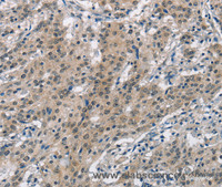 Immunohistochemistry of paraffin-embedded Human gastric cancer using SMAD9 Polyclonal Antibody at dilution of 1:30