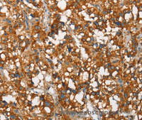 Immunohistochemistry of paraffin-embedded Human thyroid cancer tissue using SNCA Polyclonal Antibody at dilution 1:60