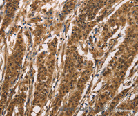 Immunohistochemistry of paraffin-embedded Human gasrtic cancer tissue using ADGRB1 Polyclonal Antibody at dilution 1:40