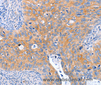 Immunohistochemistry of paraffin-embedded Human cervical cancer tissue using ABO Polyclonal Antibody at dilution 1:50
