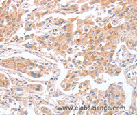 Immunohistochemistry of paraffin-embedded Human lung cancer tissue using ABO Polyclonal Antibody at dilution 1:50
