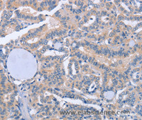 Immunohistochemistry of paraffin-embedded Human thyroid cancer tissue using BOD1 Polyclonal Antibody at dilution 1:60