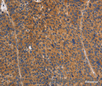 Immunohistochemistry of paraffin-embedded Human liver cancer tissue using NOD1 Polyclonal Antibody at dilution 1:50