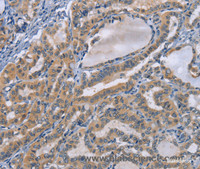 Immunohistochemistry of paraffin-embedded Human thyroid cancer tissue using TNFRSF8 Polyclonal Antibody at dilution 1:50