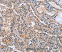 Immunohistochemistry of paraffin-embedded Human thyroid cancer tissue using CD36 Polyclonal Antibody at dilution 1:60