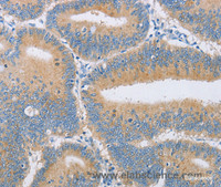 Immunohistochemistry of paraffin-embedded Human colon cancer tissue using CENPE Polyclonal Antibody at dilution 1:50