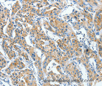 Immunohistochemistry of paraffin-embedded Human lung cancer using CKAP4 Polyclonal Antibody at dilution of 1:30