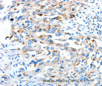 Immunohistochemistry of paraffin-embedded Human esophagus cancer tissue using CLPTM1L Polyclonal Antibody at dilution 1:60