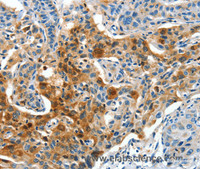 Immunohistochemistry of paraffin-embedded Human lung cancer tissue using COG1 Polyclonal Antibody at dilution 1:60