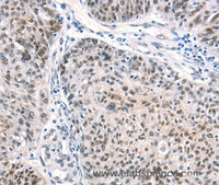 Immunohistochemistry of paraffin-embedded Human ovarian cancer using CTBP2 Polyclonal Antibody at dilution of 1:40