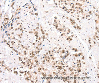 Immunohistochemistry of paraffin-embedded Human prostate cancer using CTBP2 Polyclonal Antibody at dilution of 1:40
