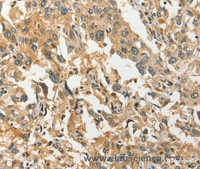 Immunohistochemistry of paraffin-embedded Human esophagus cancer tissue using DIRAS1 Polyclonal Antibody at dilution 1:30