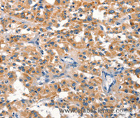 Immunohistochemistry of paraffin-embedded Human thyroid cancer using DUSP2 Polyclonal Antibody at dilution of 1:30