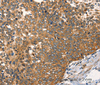 Immunohistochemistry of paraffin-embedded Human cervical cancer tissue using AGO1 Polyclonal Antibody at dilution 1:40