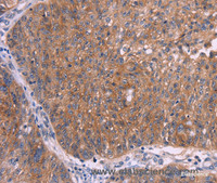 Immunohistochemistry of paraffin-embedded Human ovarian cancer tissue using EMP2 Polyclonal Antibody at dilution 1:30